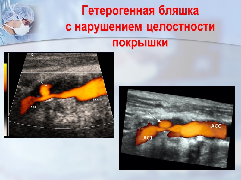 Гетерогенная бляшка            